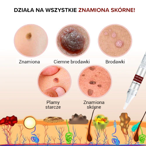 ((2024)) Krem w długopisie do usuwania mrówek, kretów i brodawek skórnych