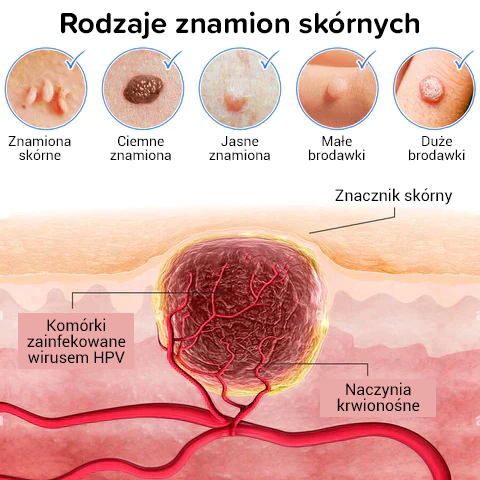 2024 Pro Kremy na niedoskonałości skóry, znamiona i brodawki!!!!